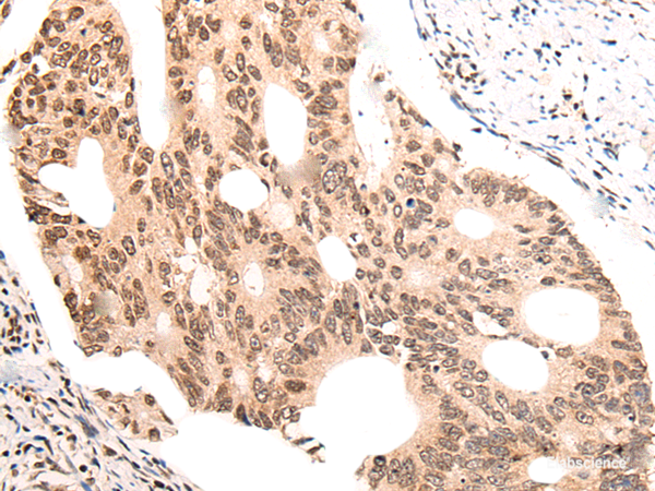 Immunohistochemistry of paraffin-embedded Human colorectal cancer tissue using KNOP1 Polyclonal Antibody at dilution of 1:55(×200)