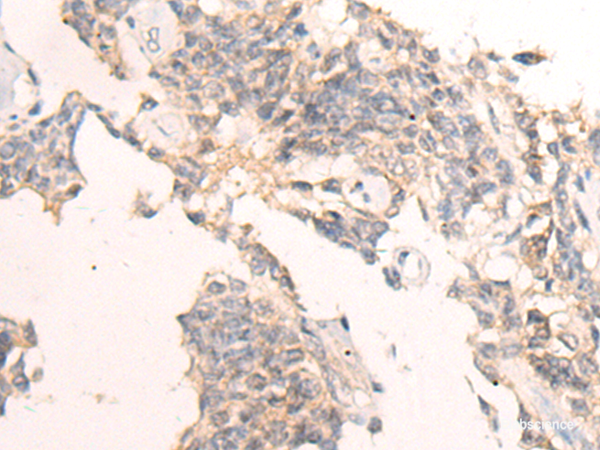 Immunohistochemistry of paraffin-embedded Human ovarian cancer tissue using IBA57 Polyclonal Antibody at dilution of 1:65(×200)
