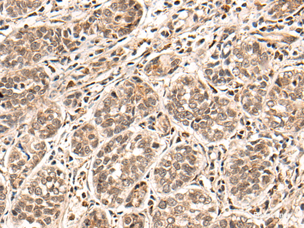 Immunohistochemistry of paraffin-embedded Human esophagus cancer tissue using HGH1 Polyclonal Antibody at dilution of 1:45(×200)