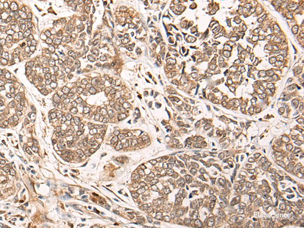 Immunohistochemistry of paraffin-embedded Human esophagus cancer tissue using CA5B Polyclonal Antibody at dilution of 1:85(×200)