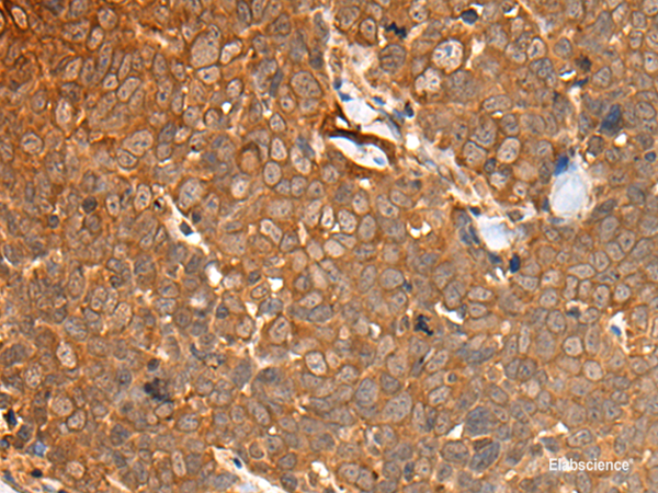 Immunohistochemistry of paraffin-embedded Human thyroid cancer tissue using CAD Polyclonal Antibody at dilution of 1:50(×200)