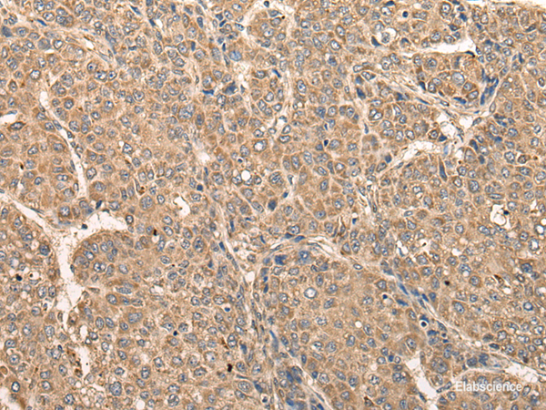Immunohistochemistry of paraffin-embedded Human liver cancer tissue using RCAN3 Polyclonal Antibody at dilution of 1:60(×200)