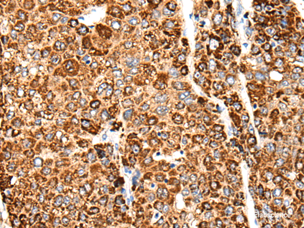 Immunohistochemistry of paraffin-embedded Human liver cancer tissue using CACNG5 Polyclonal Antibody at dilution of 1:50(×200)