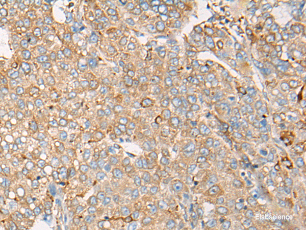 Immunohistochemistry of paraffin-embedded Human liver cancer tissue using CAPN9 Polyclonal Antibody at dilution of 1:45(×200)