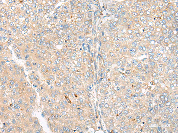 Immunohistochemistry of paraffin-embedded Human liver cancer tissue using CAMK2A Polyclonal Antibody at dilution of 1:55(×200)