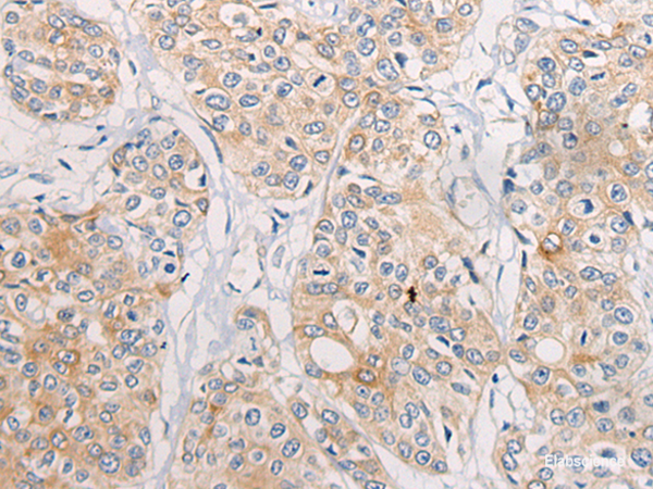 Immunohistochemistry of paraffin-embedded Human prost at e cancer tissue using CPD Polyclonal Antibody at dilution of 1:70(×200)