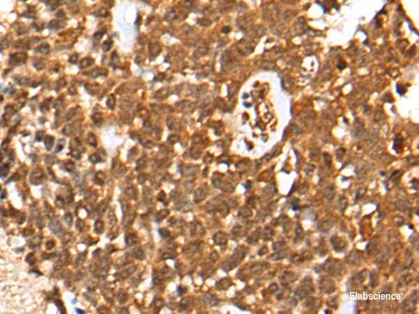Immunohistochemistry of paraffin-embedded Human thyroid cancer tissue using CASP8 Polyclonal Antibody at dilution of 1:35(×200)