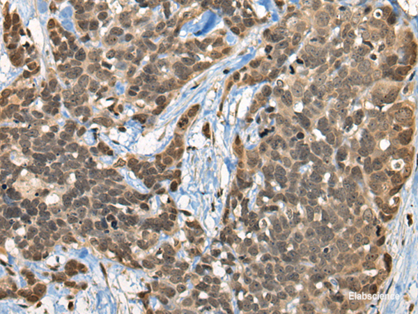 Immunohistochemistry of paraffin-embedded Human thyroid cancer tissue using CBFA2T3 Polyclonal Antibody at dilution of 1:45(×200)