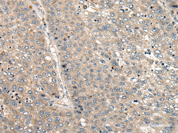 Immunohistochemistry of paraffin-embedded Human liver cancer tissue using CC2D1A Polyclonal Antibody at dilution of 1:35(×200)
