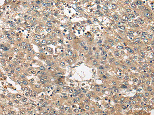 Immunohistochemistry of paraffin-embedded Human liver cancer tissue using FUT4 Polyclonal Antibody at dilution of 1:40(×200)
