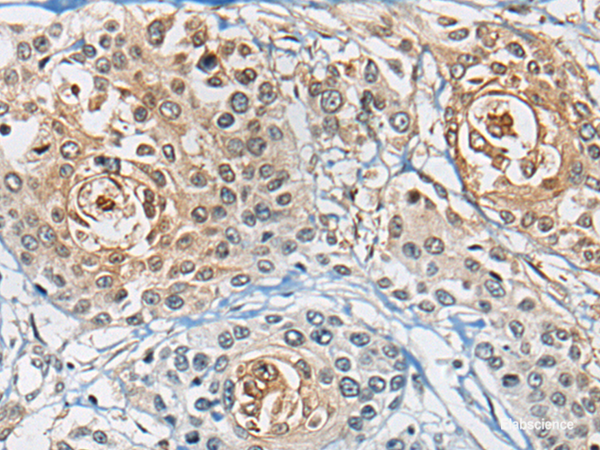 Immunohistochemistry of paraffin-embedded Human prost at e cancer tissue using CD8A Polyclonal Antibody at dilution of 1:100(×200)