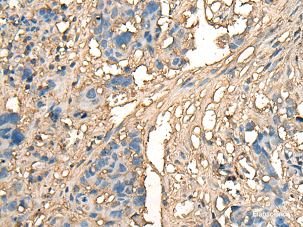 Immunohistochemistry of paraffin-embedded Human lung cancer tissue using CELA1 Polyclonal Antibody at dilution of 1:70(×200)