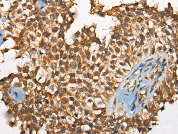 Immunohistochemistry of paraffin-embedded Human ovarian cancer tissue using ODF2 Polyclonal Antibody at dilution of 1:110(×200)