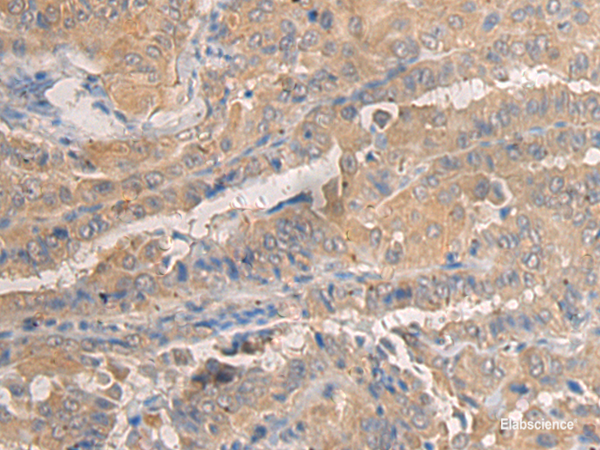 Immunohistochemistry of paraffin-embedded Human thyroid cancer tissue using AGAP3 Polyclonal Antibody at dilution of 1:25(×200)