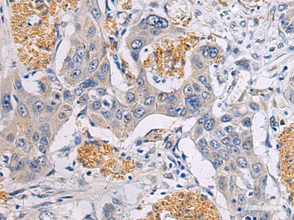 Immunohistochemistry of paraffin-embedded Human esophagus cancer tissue using CHST3 Polyclonal Antibody at dilution of 1:30(×200)