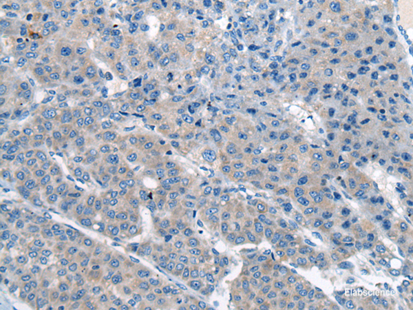 Immunohistochemistry of paraffin-embedded Human liver cancer tissue using CITED4 Polyclonal Antibody at dilution of 1:65(×200)