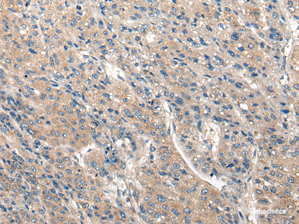 Immunohistochemistry of paraffin-embedded Human liver cancer tissue using CLIC6 Polyclonal Antibody at dilution of 1:40(×200)