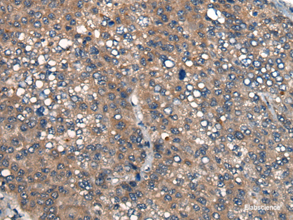 Immunohistochemistry of paraffin-embedded Human liver cancer tissue using ICMT Polyclonal Antibody at dilution of 1:45(×200)