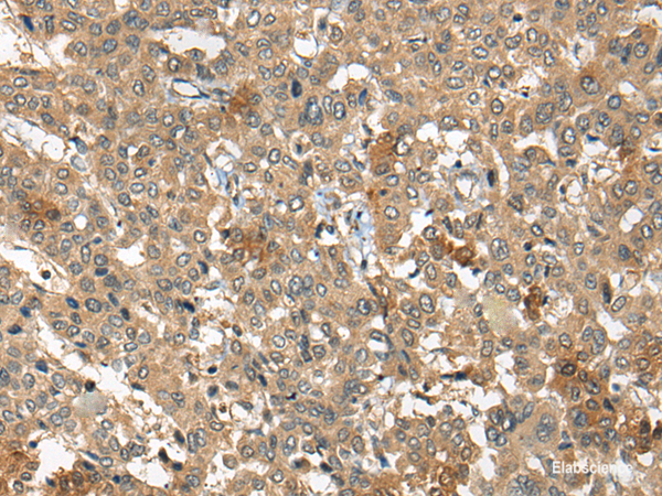 Immunohistochemistry of paraffin-embedded Human liver cancer tissue using ARCN1 Polyclonal Antibody at dilution of 1:50(×200)