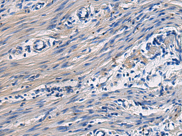 Immunohistochemistry of paraffin-embedded Human colorectal cancer tissue using COL17A1 Polyclonal Antibody at dilution of 1:50(×200)