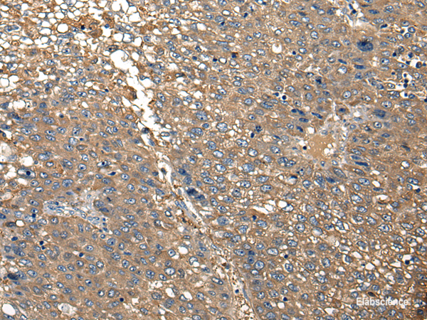 Immunohistochemistry of paraffin-embedded Human liver cancer tissue using DGKI Polyclonal Antibody at dilution of 1:30(×200)
