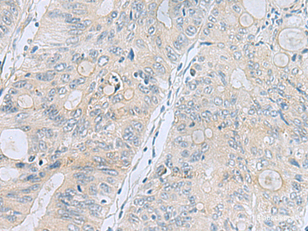 Immunohistochemistry of paraffin-embedded Human colorectal cancer tissue using APOBR Polyclonal Antibody at dilution of 1:35(×200)