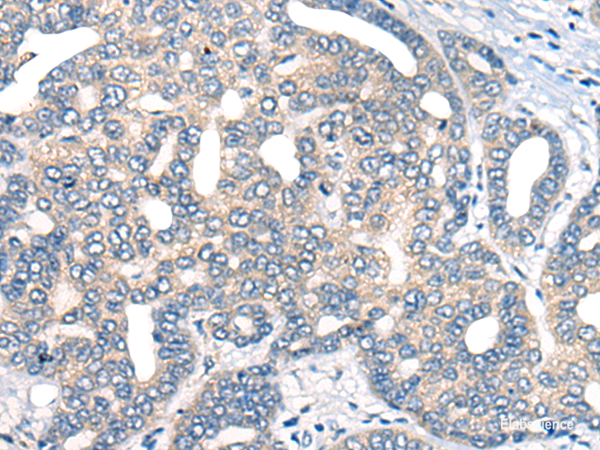 Immunohistochemistry of paraffin-embedded Human liver cancer tissue using AURKA Polyclonal Antibody at dilution of 1:40(×200)
