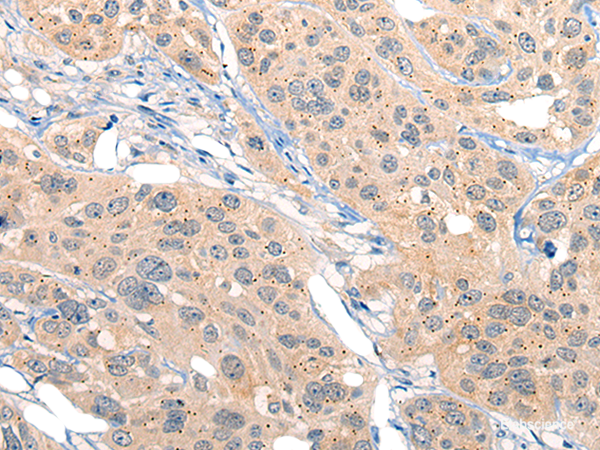 Immunohistochemistry of paraffin-embedded Human esophagus cancer tissue using MIIP Polyclonal Antibody at dilution of 1:45(×200)