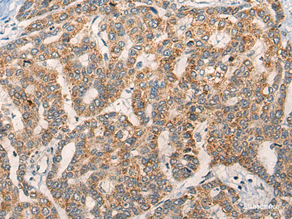 Immunohistochemistry of paraffin-embedded Human liver cancer tissue using NLGN1 Polyclonal Antibody at dilution of 1:50(×200)