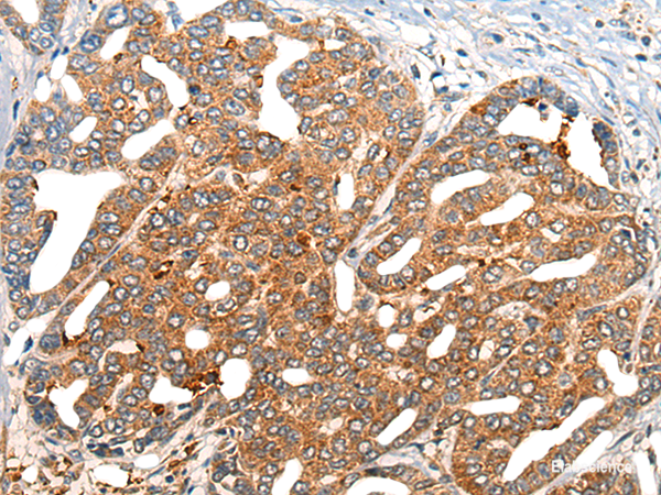 Immunohistochemistry of paraffin-embedded Human liver cancer tissue using NOG Polyclonal Antibody at dilution of 1:40(×200)