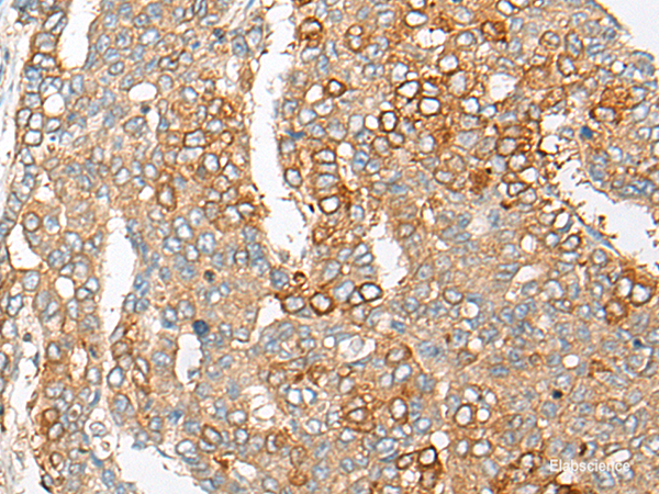 Immunohistochemistry of paraffin-embedded Human liver cancer tissue using PCDHGB5 Polyclonal Antibody at dilution of 1:35(×200)