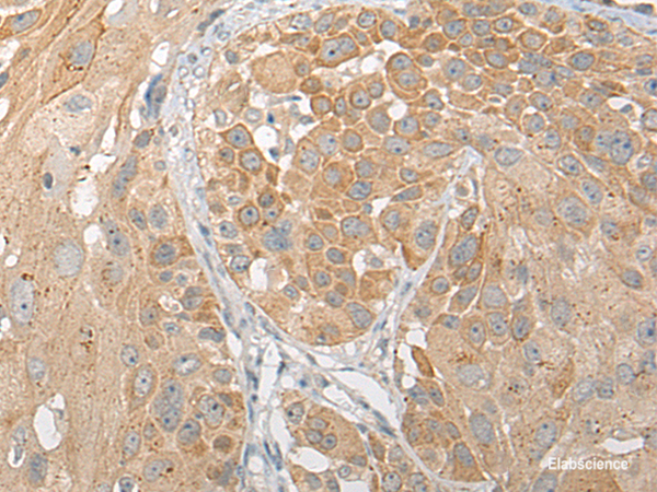 Immunohistochemistry of paraffin-embedded Human esophagus cancer tissue using SNX6 Polyclonal Antibody at dilution of 1:50(×200)