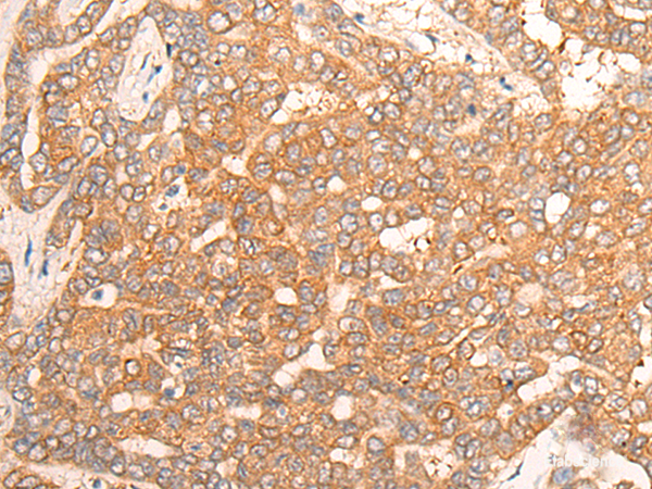 Immunohistochemistry of paraffin-embedded Human liver cancer tissue using CPS1 Polyclonal Antibody at dilution of 1:35(×200)