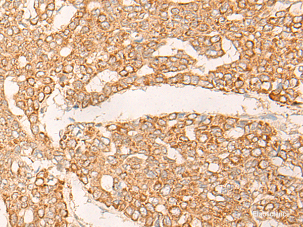 Immunohistochemistry of paraffin-embedded Human liver cancer tissue using KRT9 Polyclonal Antibody at dilution of 1:30(×200)