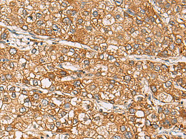 Immunohistochemistry of paraffin-embedded Human liver cancer tissue using DCAF12 Polyclonal Antibody at dilution of 1:65(×200)