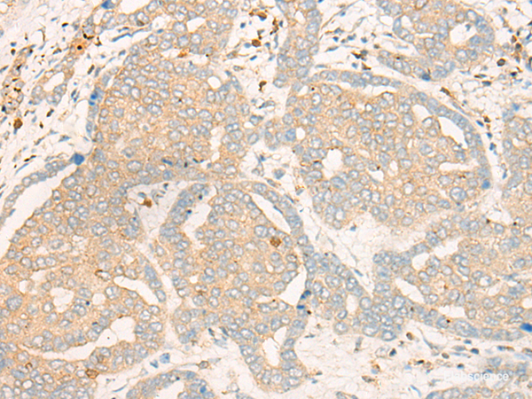 Immunohistochemistry of paraffin-embedded Human liver cancer tissue using FBXO32 Polyclonal Antibody at dilution of 1:35(×200)