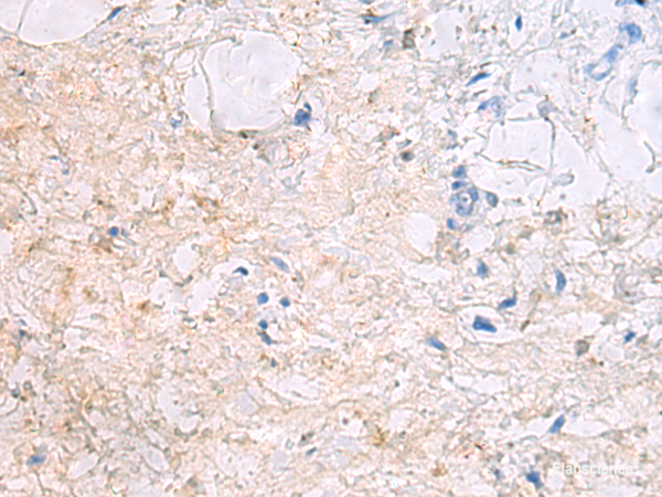 Immunohistochemistry of paraffin-embedded Human gastric cancer tissue using DPCD Polyclonal Antibody at dilution of 1:50(×200)