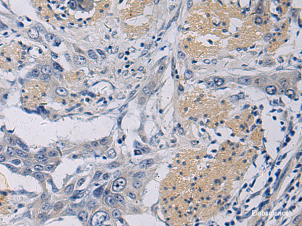 Immunohistochemistry of paraffin-embedded Human esophagus cancer tissue using KLF1 Polyclonal Antibody at dilution of 1:35(×200)