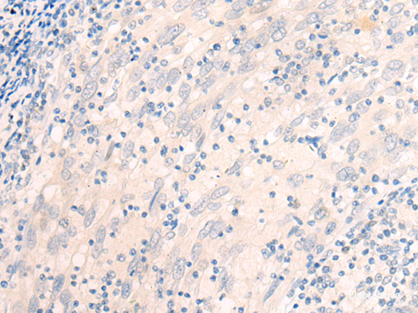 Immunohistochemistry of paraffin-embedded Human cervical cancer tissue using EME2 Polyclonal Antibody at dilution of 1:40(×200)