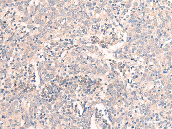 Immunohistochemistry of paraffin-embedded Human cervical cancer tissue using EMX1 Polyclonal Antibody at dilution of 1:25(×200)