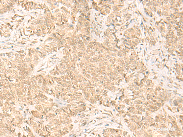 Immunohistochemistry of paraffin-embedded Human ovarian cancer tissue using IL32 Polyclonal Antibody at dilution of 1:45(×200)
