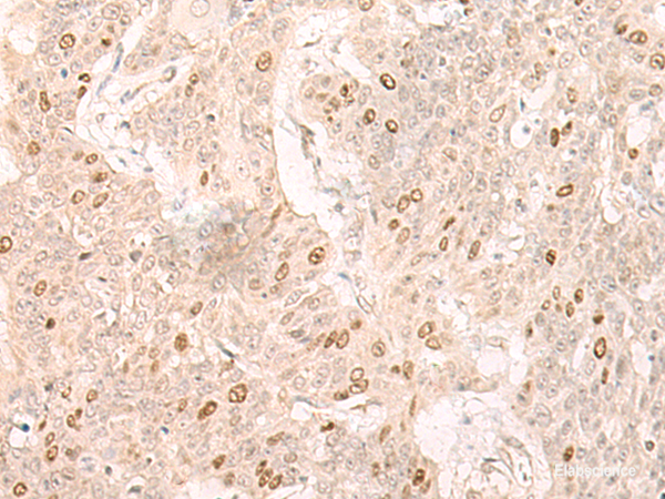 Immunohistochemistry of paraffin-embedded Human esophagus cancer tissue using IL7 Polyclonal Antibody at dilution of 1:30(×200)