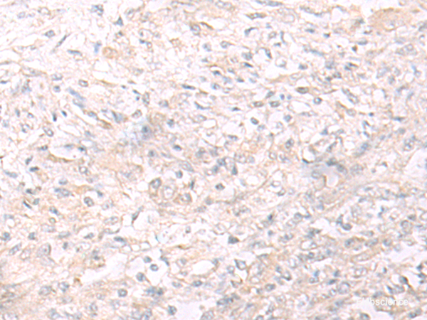 Immunohistochemistry of paraffin-embedded Human liver cancer tissue using IL26 Polyclonal Antibody at dilution of 1:65(×200)