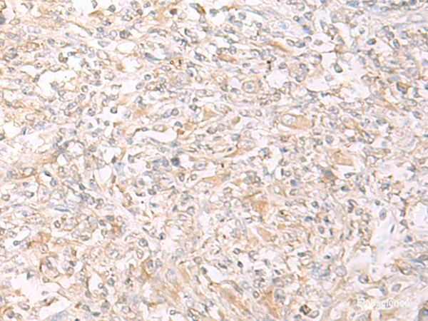 Immunohistochemistry of paraffin-embedded Human liver cancer tissue using IL12B Polyclonal Antibody at dilution of 1:45(×200)