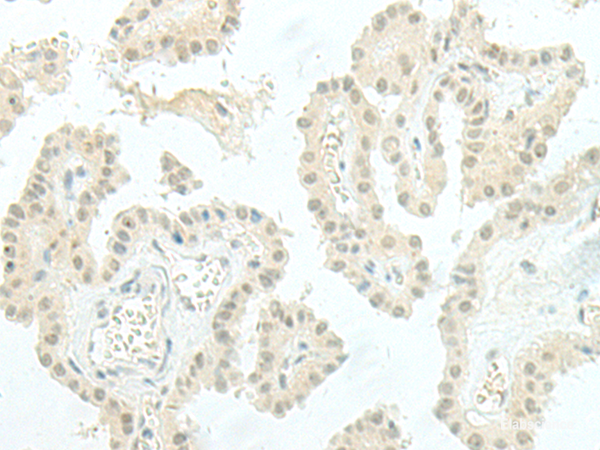 Immunohistochemistry of paraffin-embedded Human thyroid cancer tissue using ESRP2 Polyclonal Antibody at dilution of 1:95(×200)