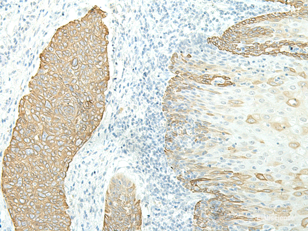 Immunohistochemistry of paraffin-embedded Human esophagus cancer tissue using ETAA1 Polyclonal Antibody at dilution of 1:40(×200)