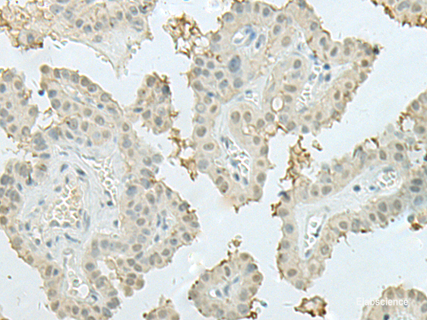 Immunohistochemistry of paraffin-embedded Human thyroid cancer tissue using MECOM Polyclonal Antibody at dilution of 1:60(×200)
