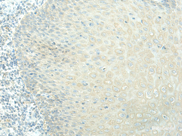 Immunohistochemistry of paraffin-embedded Human esophagus cancer tissue using EVI2B Polyclonal Antibody at dilution of 1:40(×200)