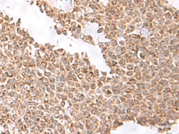 Immunohistochemistry of paraffin-embedded Human ovarian cancer tissue using USP16 Polyclonal Antibody at dilution of 1:75(×200)