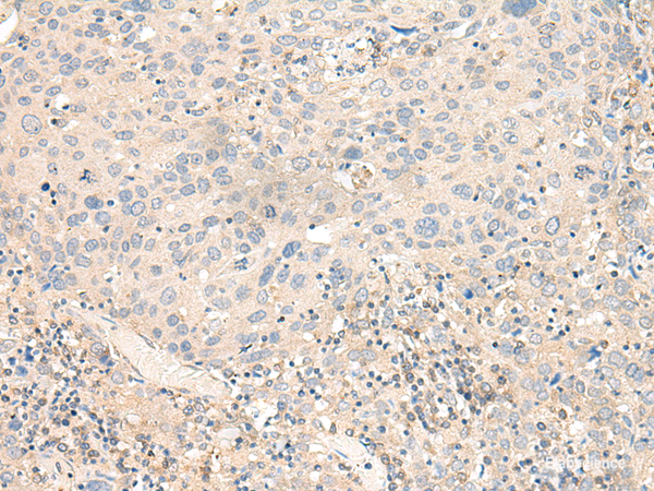 Immunohistochemistry of paraffin-embedded Human cervical cancer tissue using KCNA10 Polyclonal Antibody at dilution of 1:40(×200)